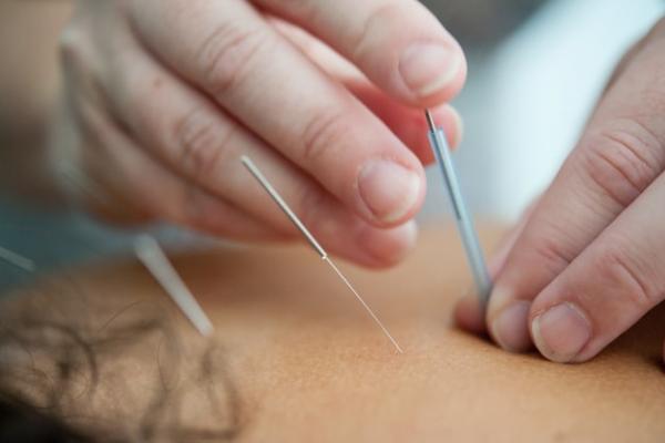 Acupuncture 